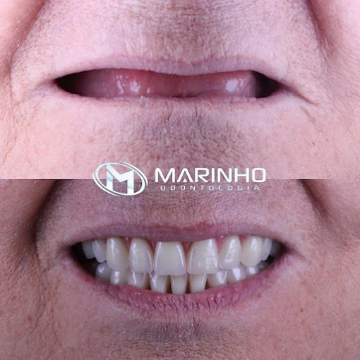 Antes e depois — implante caso 1