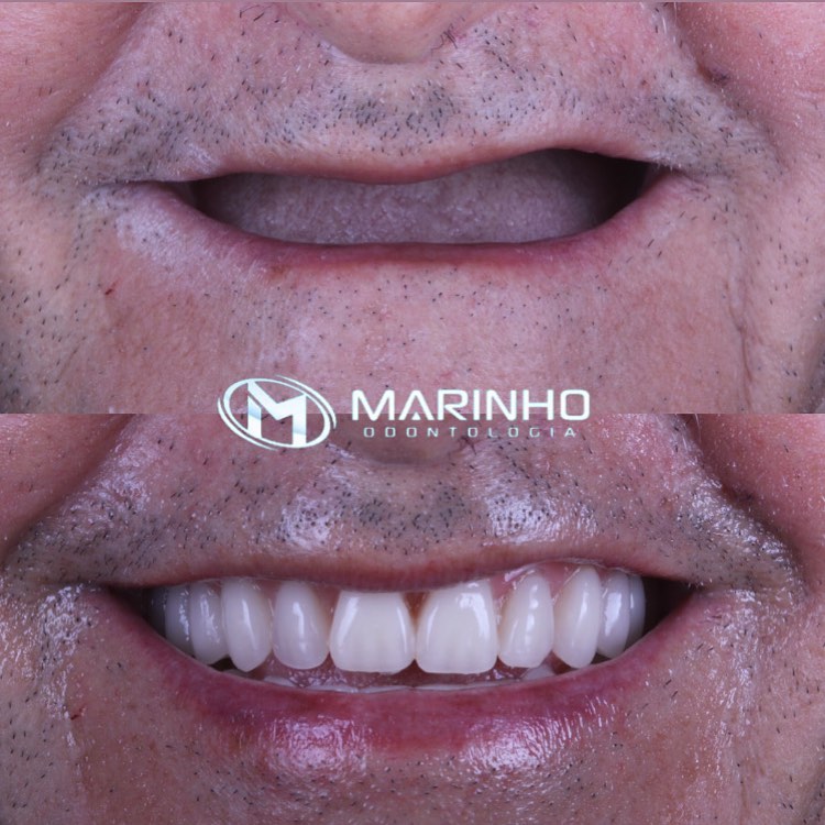 Antes e depois — implante caso 3