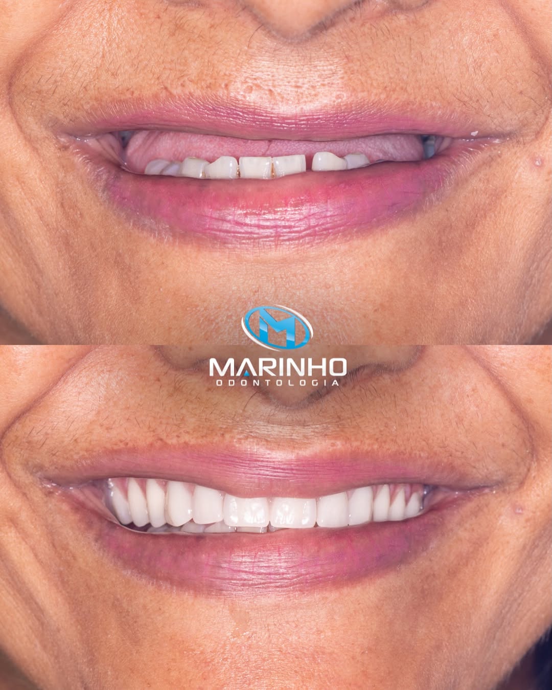 Antes e depois — implante caso 4
