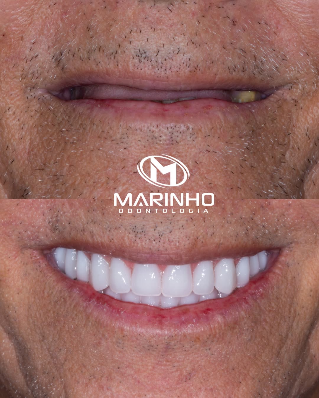 Antes e depois — implante caso 5