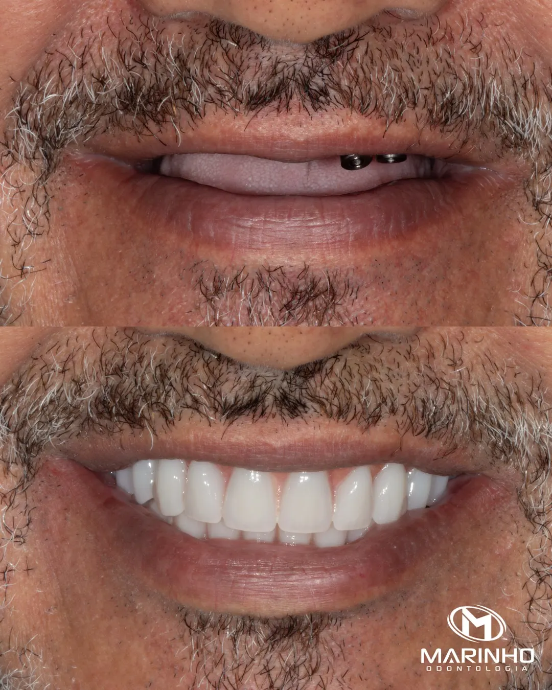 Antes e depois — implante caso 6