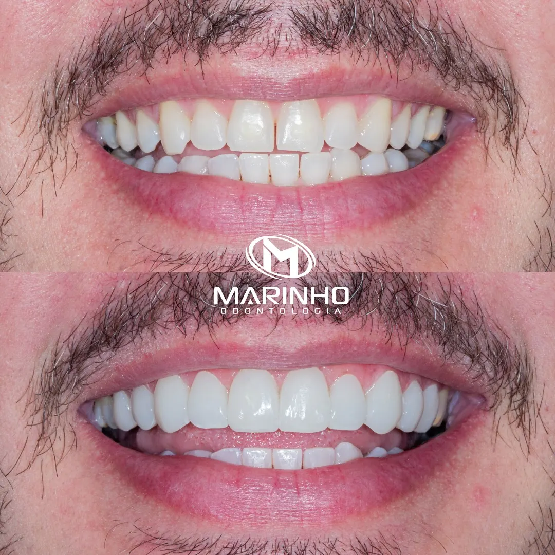Antes e depois — lentes caso 1