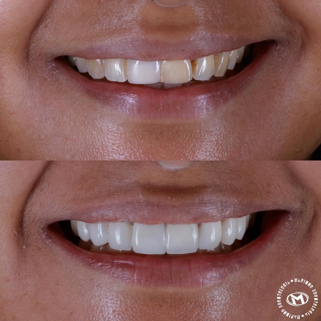 Antes e depois — lentes caso 3