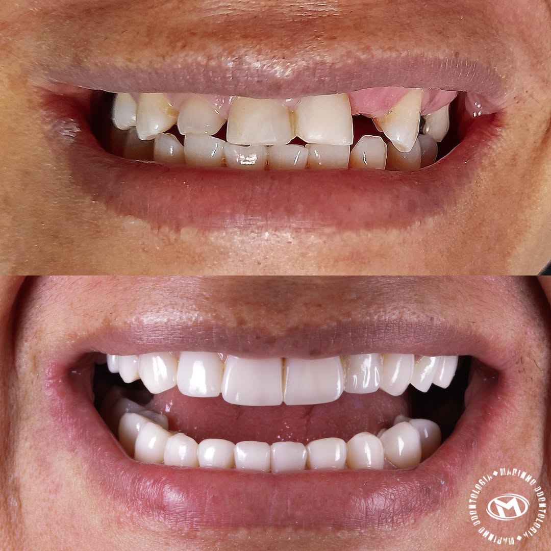 Antes e depois — lentes caso 4