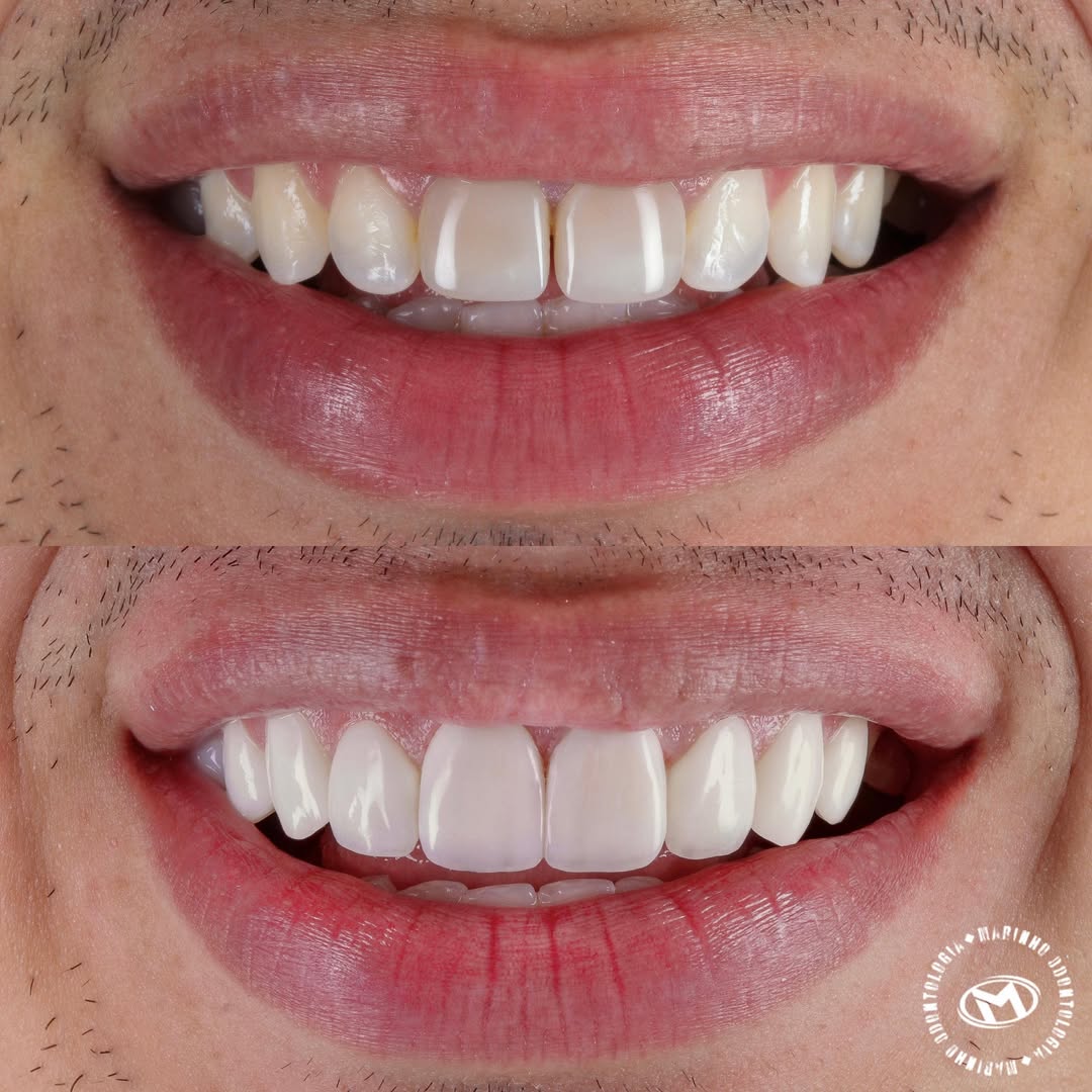 Antes e depois — lentes caso 5