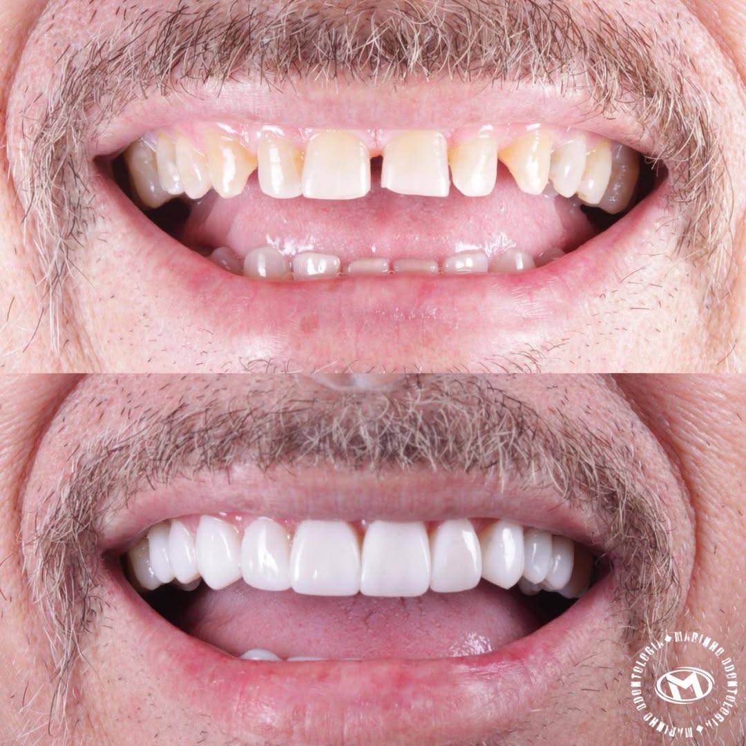 Antes e depois — lentes caso 6